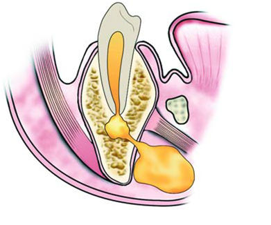 Abcesul dentar