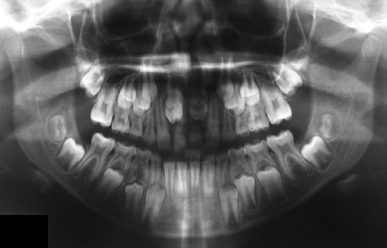 Anomalii dentare de numar